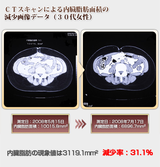 CTスキャンによる内臓脂肪面積の減少画像データ(30代女性)